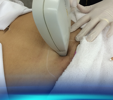 Fotoepilação a Laser | R$ 350,00 (12x de R$ 29,17)
